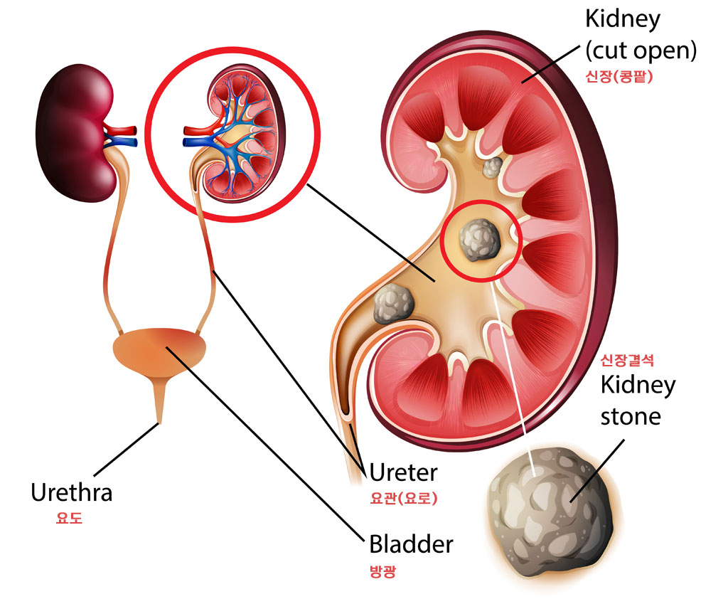 요로결석-이해도